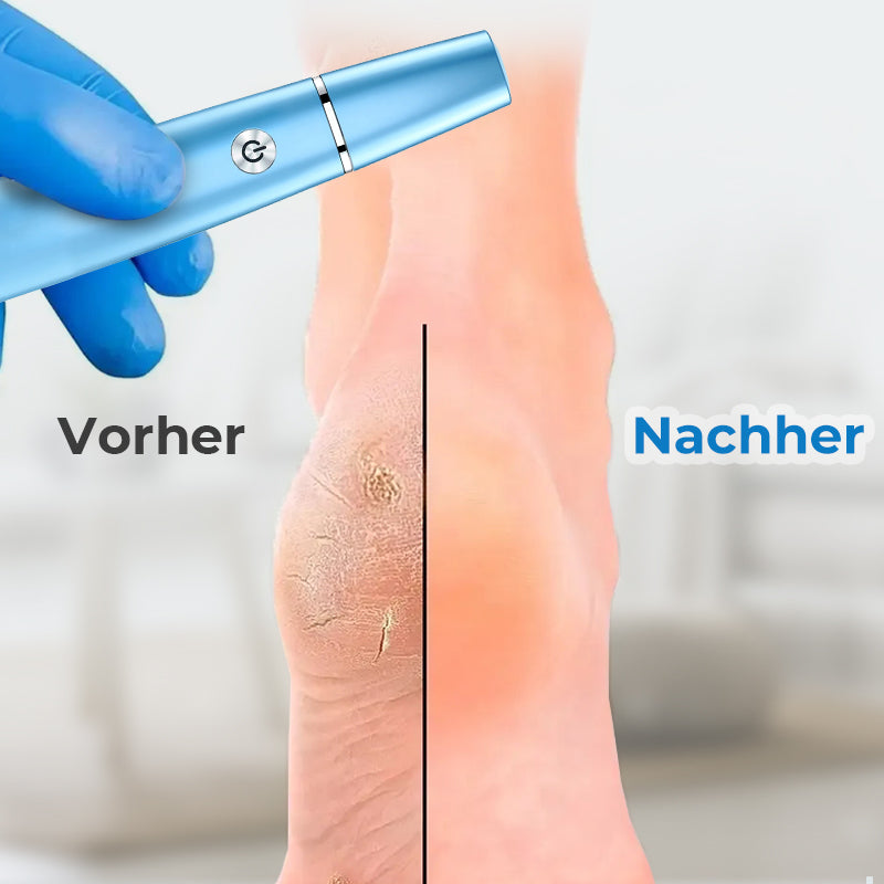 Elektrischer Hornhautentferner für die Füße